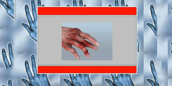ameliorați rapid inflamația articulațiilor degetelor simptomele artritei mâinii drepte