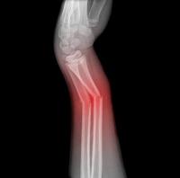 artroza liječenja gimnastike ramenog zgloba