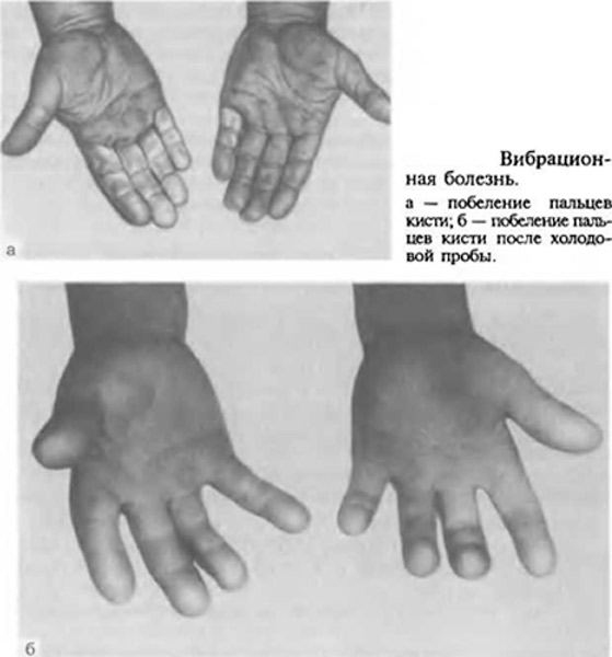 ameliorați rapid inflamația articulațiilor degetelor