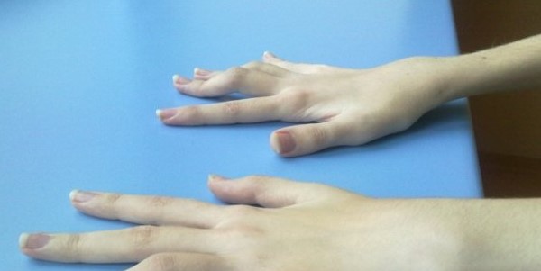 ameliorați rapid inflamația articulațiilor degetelor