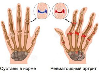 artrita crunch degetelor
