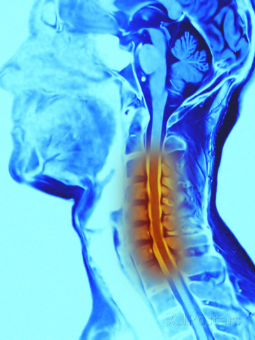 kenőcső nyaki és mellkasi osteochondrozishoz ha minden ízület fáj, mint kezelni