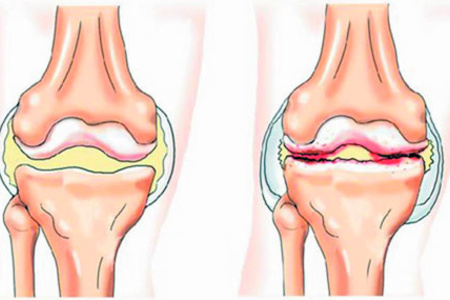 inflamația ligamentelor articulației piciorului
