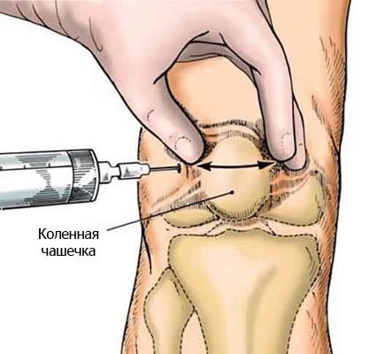 medicină comună rusvisk tratamentul articulației