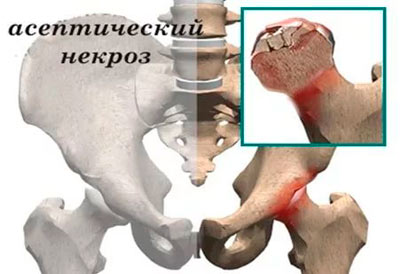 vânătaia durerii articulațiilor umărului ce este tratamentul ligamentului cruciat anterior al genunchiului